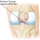 Image of Posterior Cruciate Ligament (PCL) Injuries